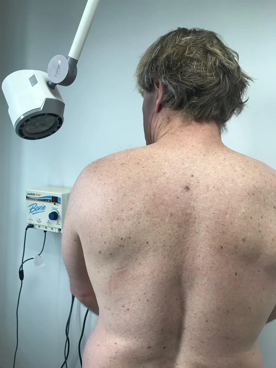 That small scab is where the doctor initially removed the spot and sent it for testing