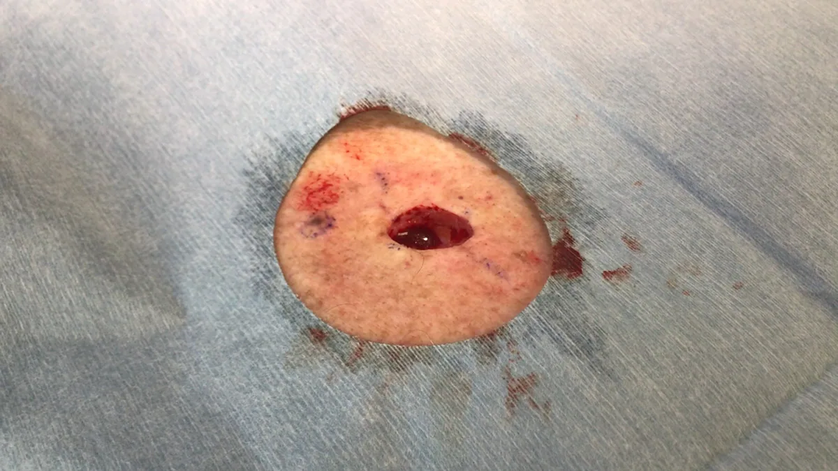 Pixellated for the faint of heart – click the image to see the uncensored photo of the great hole the doctor had to cut in my back to remove all the surrounding tissue