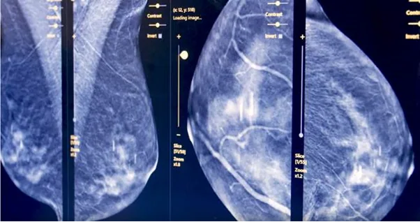 The 4-view helps radiologist see the cancer