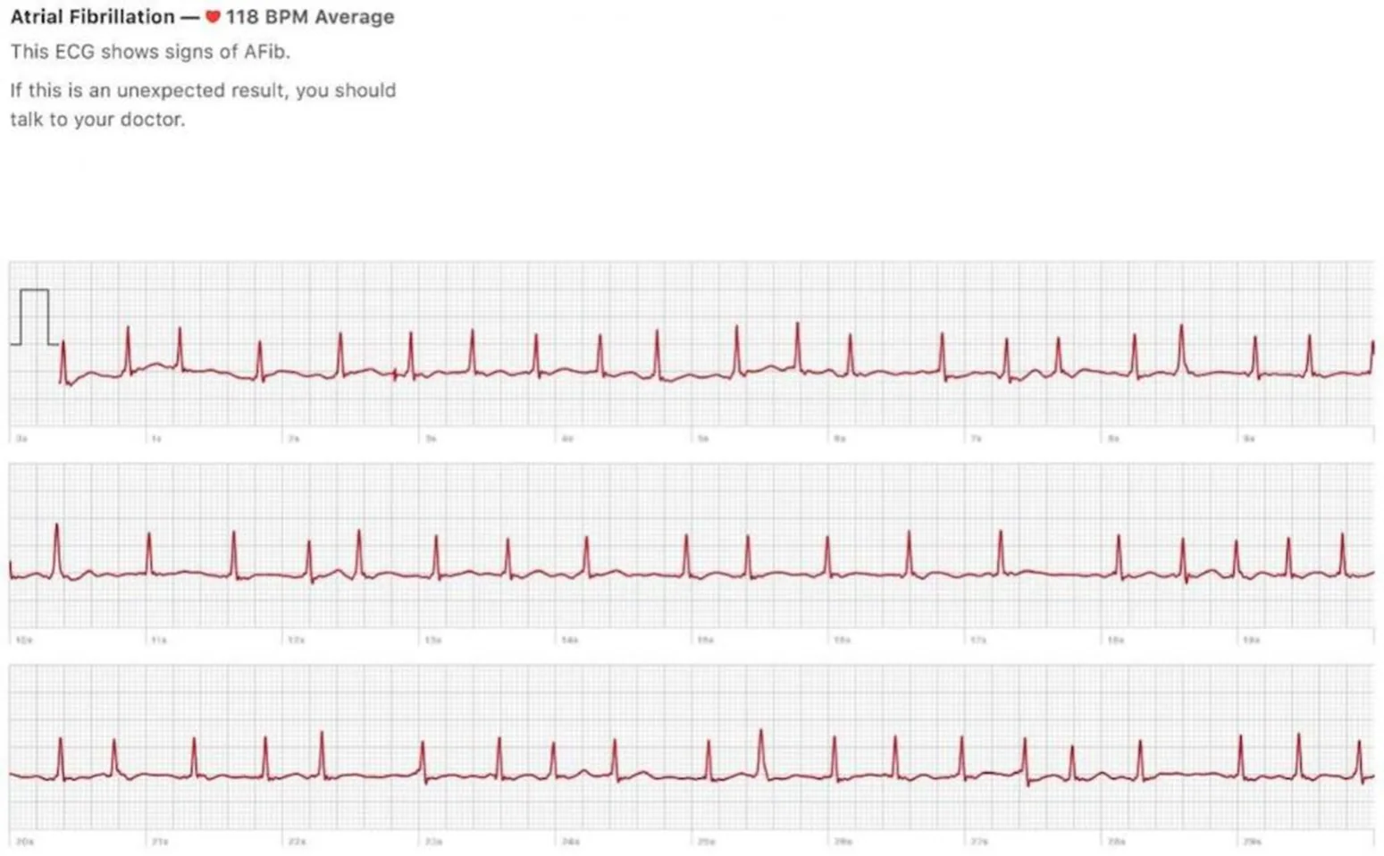 AFib ECG from Apple watch