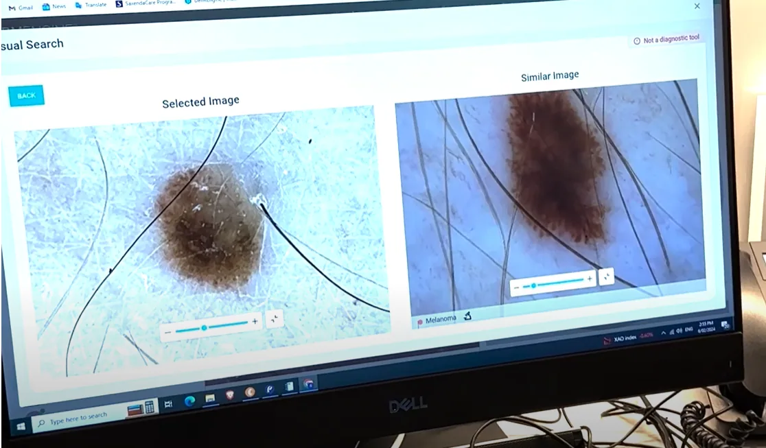AI comparing melanomas