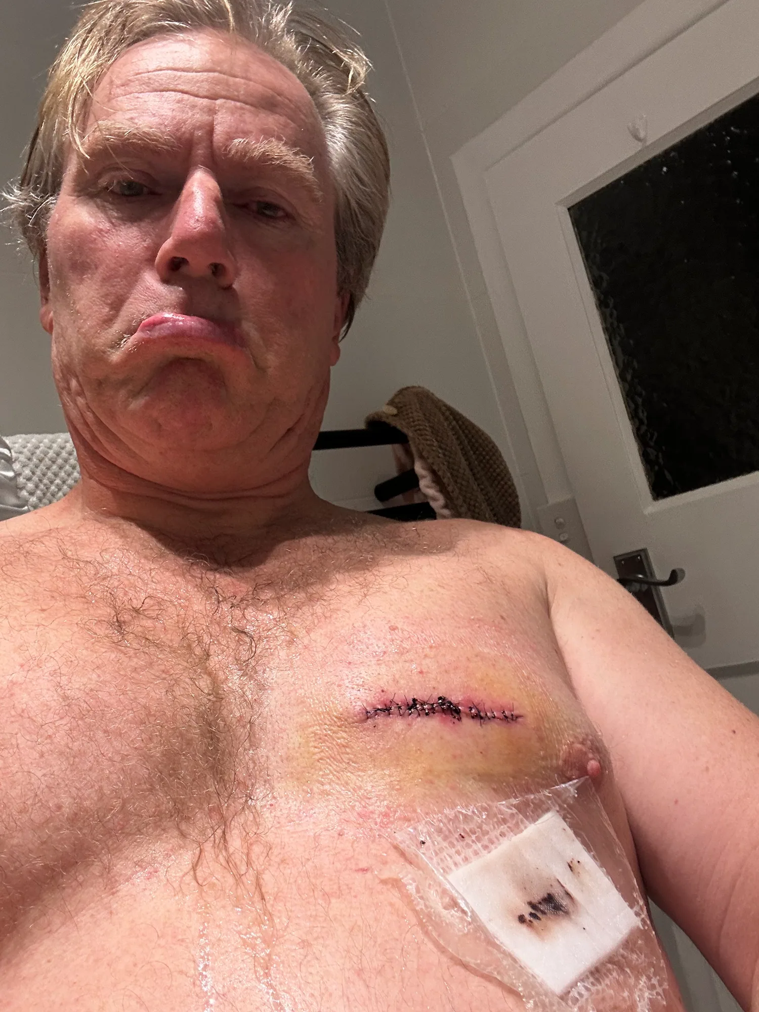 Adam Cogan sharing his melanoma removal site